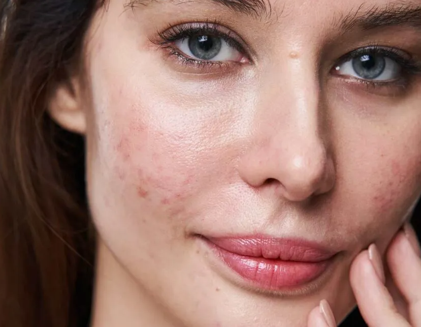 Zabieg na przebarwienia po trądziku